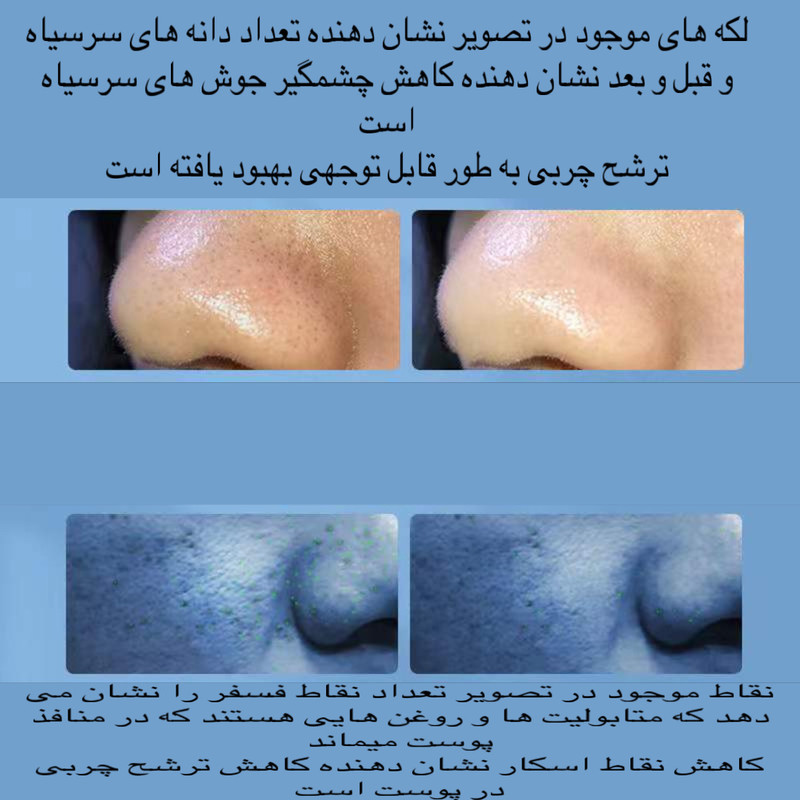 میکرودرم خانگی مدل Super Micro Bubble