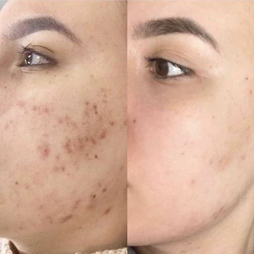 سرم آمپول لایه بردار و روشن کننده پیل شات برنج دکتر ملاکسین